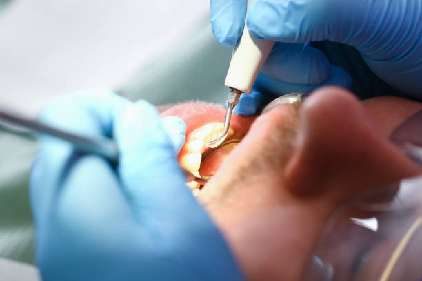 Best Emergency Wisdom Teeth Removal in Oxford, OH